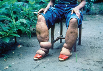 Swollen legs, caused by a parasitic worm